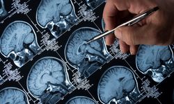 Lityum Alzheimer'ı Durdurabilir mi? Yeni Araştırma Umut Verdi