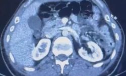 İranlı şüphelilerin midelerinde uyuşturucu tespit edildi; 3 gözaltı