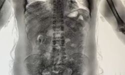 2025’te İstanbul Havalimanı’nda ‘yutucu’ kuryelerden 29,7 kilo uyuşturucu ele geçirildi