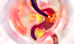 'Çoğu zaman endoskopi ve kolonoskopi yapılmasının nedeni, gereksiz yere kullanılan aspirin'