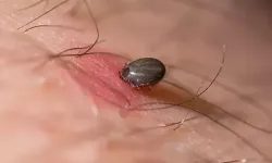 Tokat'ta KKKA hastalığı şüphesiyle tedavi gören kadın hayatını kaybetti