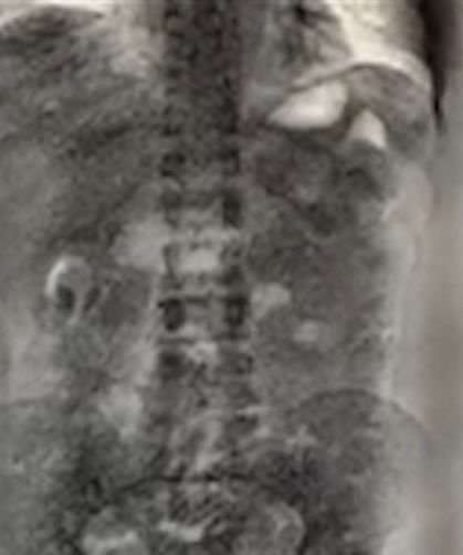 2025’te İstanbul Havalimanı’nda ‘yutucu’ kuryelerden 29,7 kilo uyuşturucu ele geçirildi