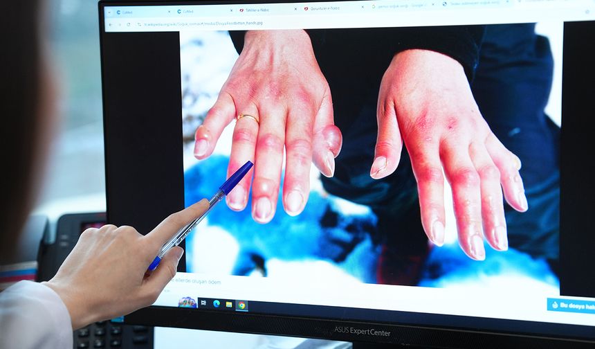 ‘Kış aylarında soğuk ısırığı vakaları artıyor’