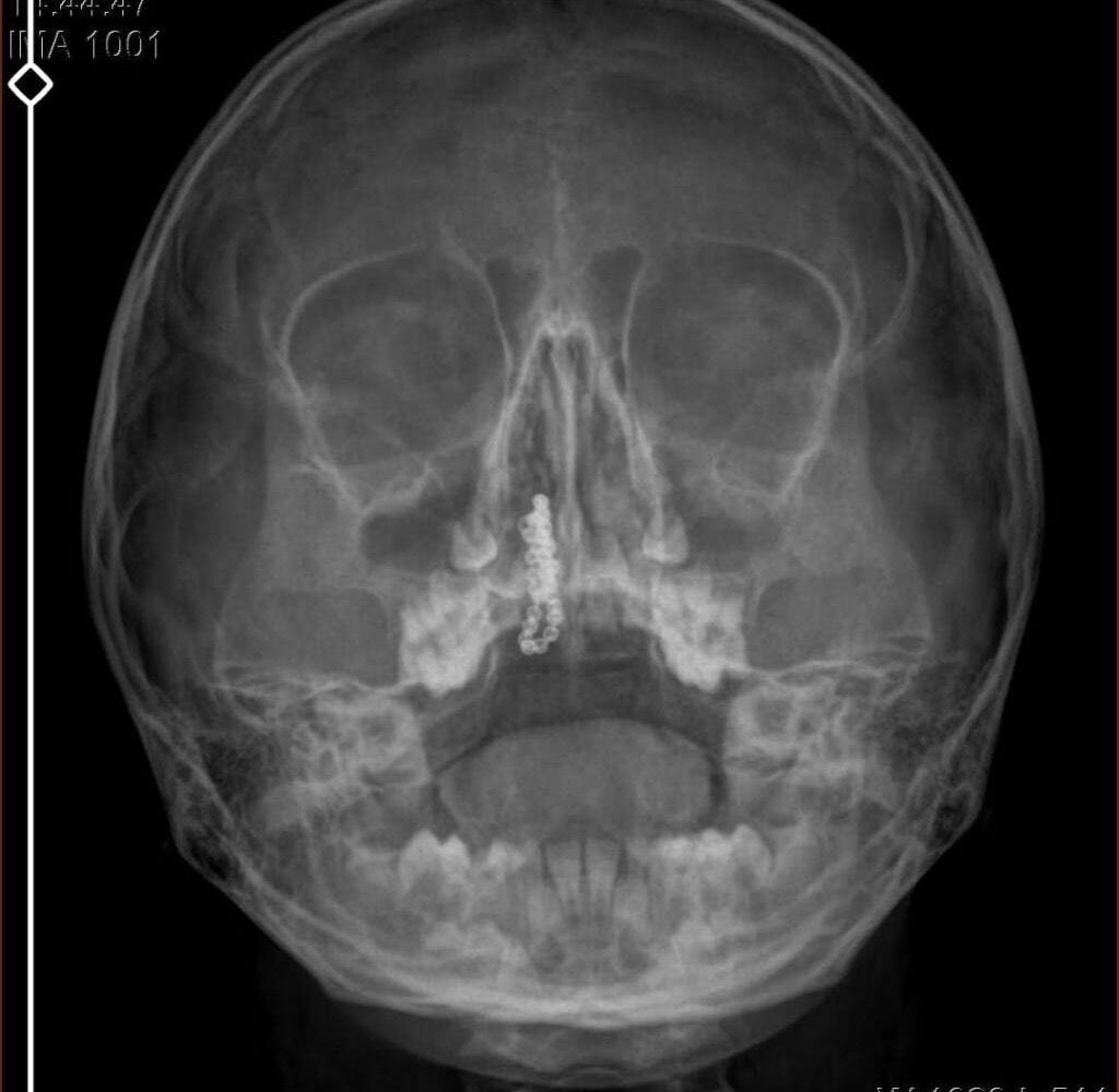 5 Y A S I N D A K I P O L E N 2 Y I L D I R B U R N U N D A T I R 1230911 366118